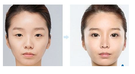 上眼睑下垂的应该怎么办呢