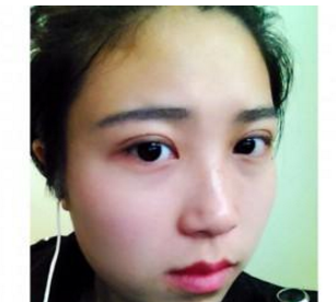 割双眼皮手术  大眼睛真的好迷人啊 - 珍美网