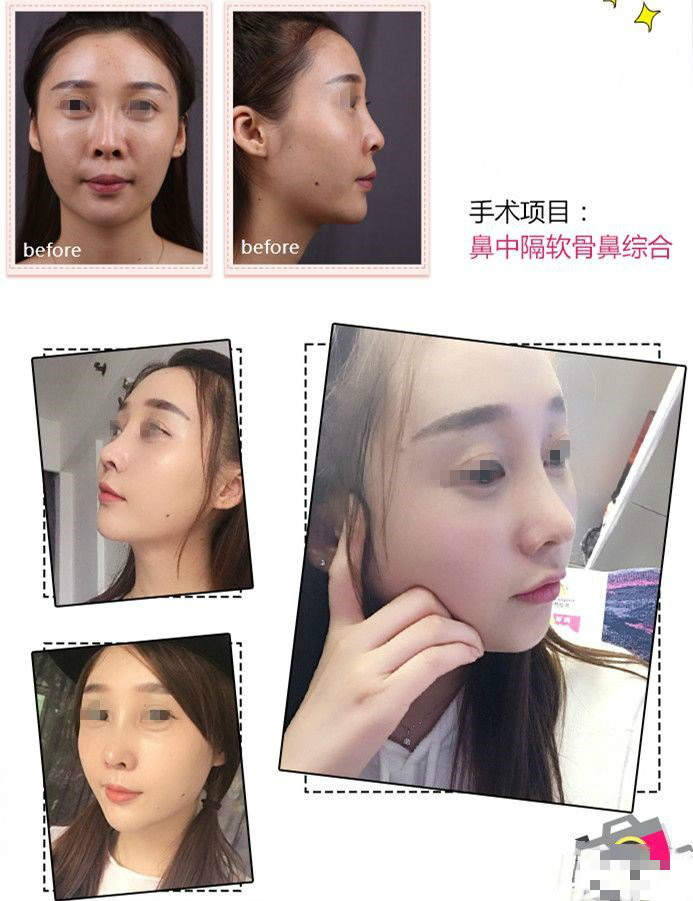 上海华美谢卫国和王会勇什么隆鼻好价钱多少