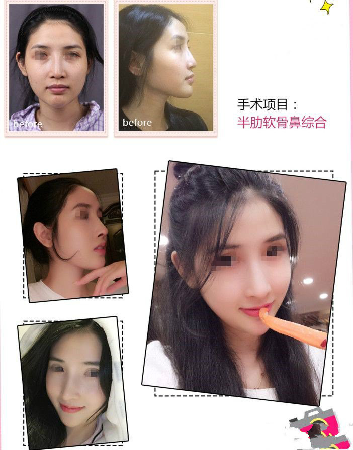 上海华美谢卫国和王会勇什么隆鼻好价钱多少