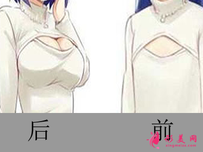 自体脂肪丰胸_自体脂肪丰胸有什么优势你知不知道