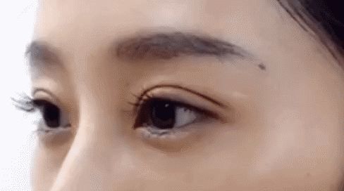 割眼睛皮后睁眼困难如何解决?