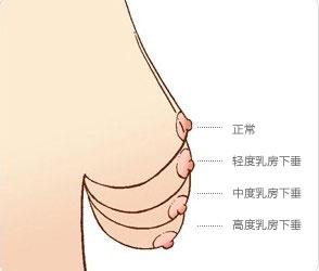 乳房下垂有哪些风险