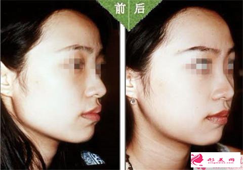 颧骨降低术的适用人群_哪些人不能做颧骨降低术