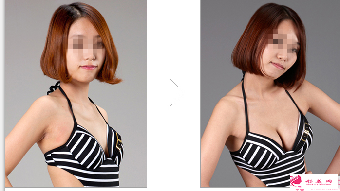 假体隆胸后的护理_假体隆胸后该如何按摩乳房？