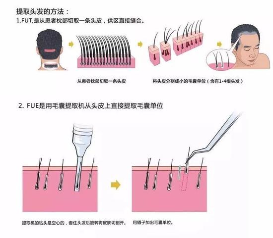 做植发整形术后头顶的毛发多久生出来?