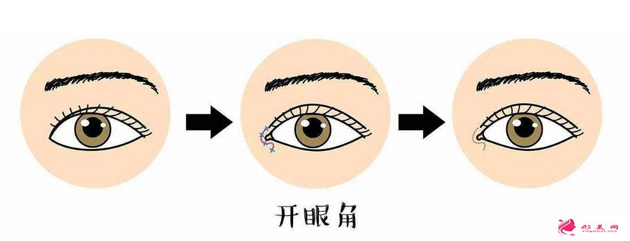 什么人合适开眼角