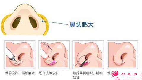 鼻翼缩小手术步骤和疤痕护理