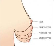 怎么判断乳房下垂的程度是否严重？