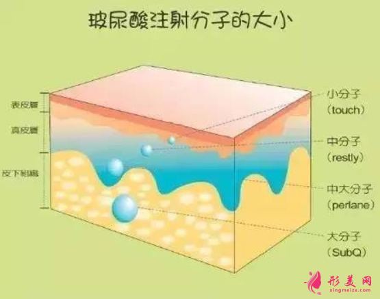 玻尿酸丰额头要多久消肿
