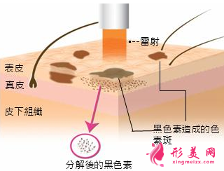 激光祛斑对皮肤有损伤吗