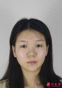 苏州美贝尔整形美容医院双眼皮手术怎么样？