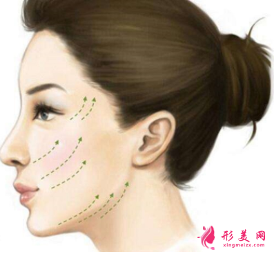 脸部埋线提升可以保持多久