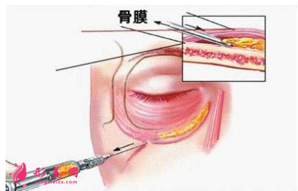 泪沟填充价格是多少？填充效果如何？