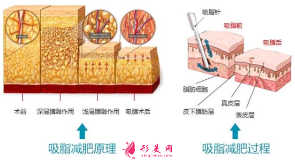 腰腹部吸脂后几天可以上班？