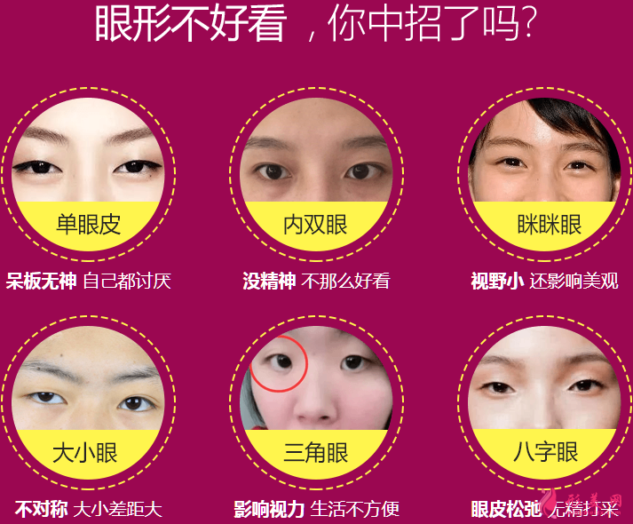 广州美莱做眼睛皮的效果如何