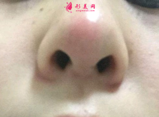 隆鼻失败多长时间可以做修复手术？