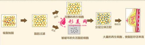 自己脂肪隆胸手术比假体怎么样？有什么不同？