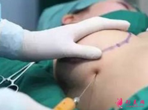自体脂肪隆胸出现硬块怎么办