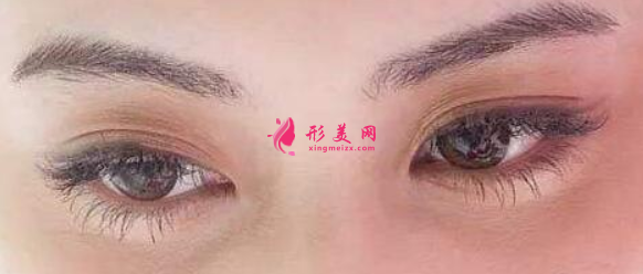 眼睛皮手术后如何迅速恢复？