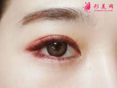 开眼角容易见到的手术办法？术后应该注意什么？