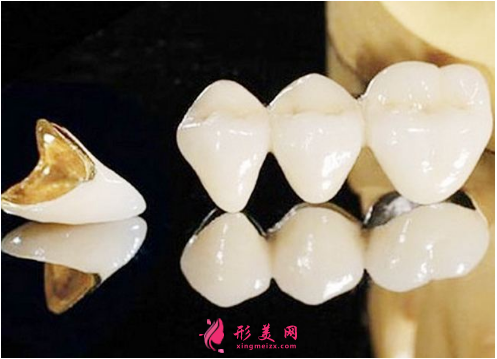 烤瓷牙材料哪种最好类型价格~