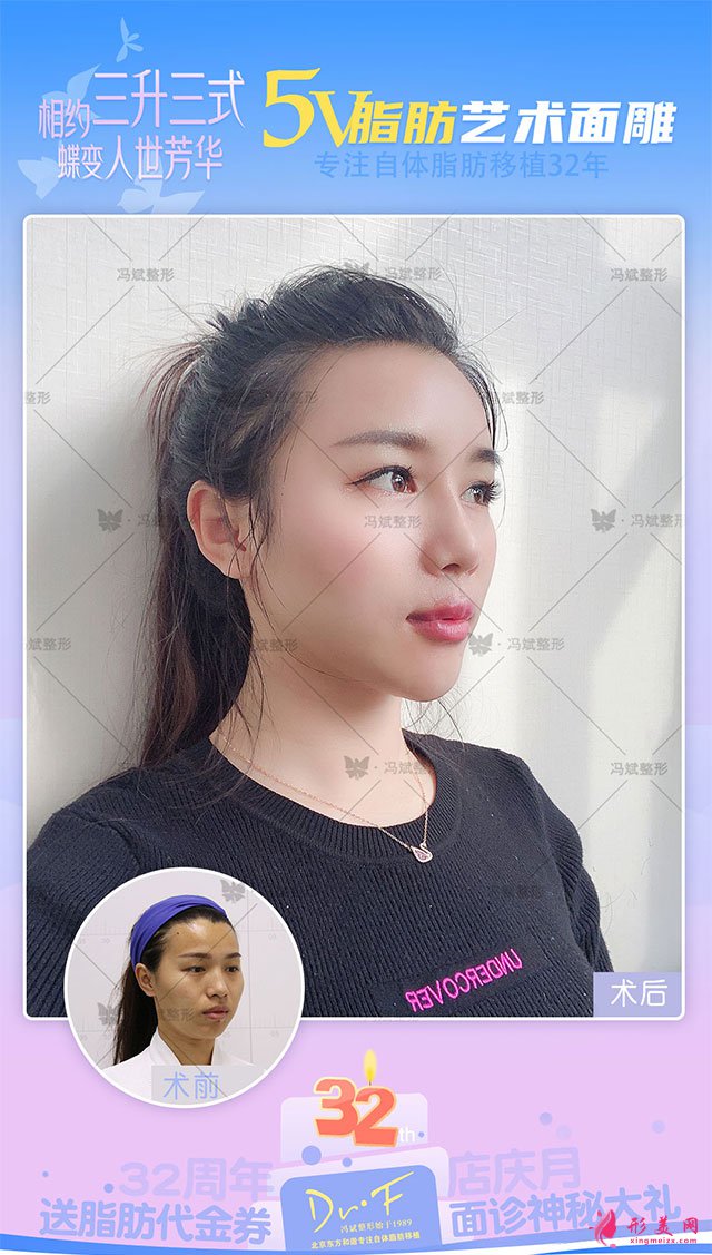 北京纯脂冯斌面部吸脂安不安全