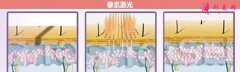 像素激光多少钱一次？术后注意事项有哪些？