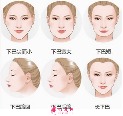 都说膨体容易感染，膨体垫下巴到底值不值得做？