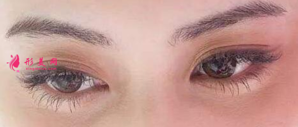 广州割眼睛皮的成效自然吗？