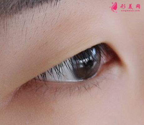 内双并且上眼皮脂肪厚怎么办