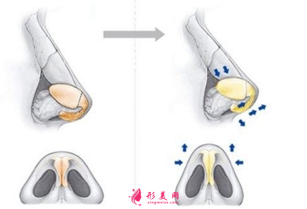 解读鼻尖缩小整形手术，术后注意事项大全~