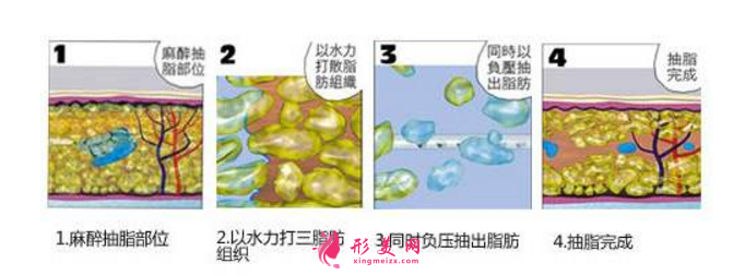 上臂吸脂后臂肿胀怎么办？术后护理要牢记！