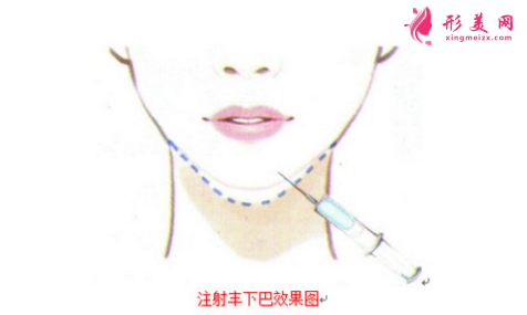 自体脂肪丰下巴和玻尿酸丰下巴哪个好