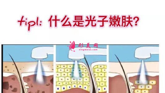 【美丽加分】面部光子嫩肤能带来哪些效果？