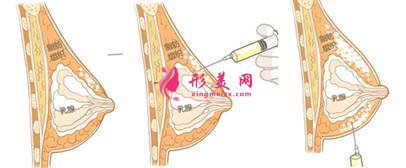 自体脂肪隆胸怎么样？术前筹备工作要了解！