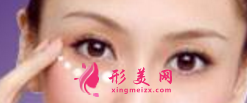 手术切除眼袋后疼不疼