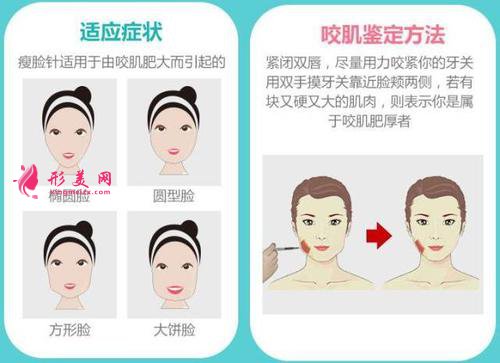 郑州整形医院瘦脸针有成效吗术后需要注意的地方