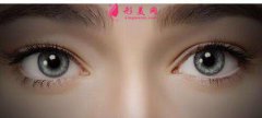 想要大眼睛！真的是爱了！美杜莎综合美眼效果好吗？