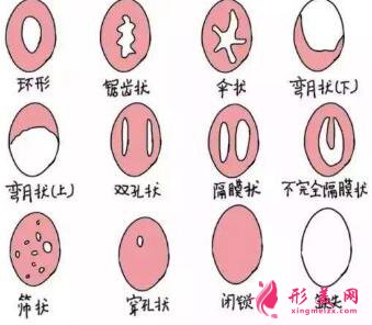 处女膜修复是怎么做的？手术大概流程