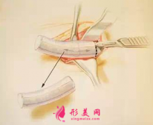 自体软骨隆鼻后会钙化吗？