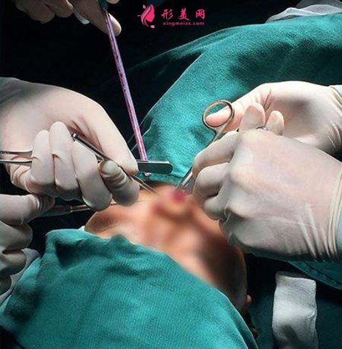 鼻综合手术正在进行
