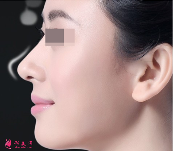 做假体隆鼻有没不良反应?
