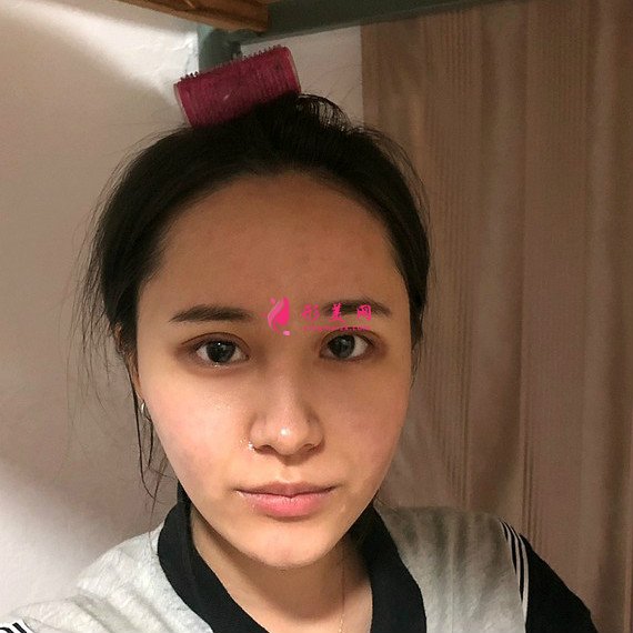 重庆美禅整形医院做的全切双眼皮效果还不错 重庆美禅整形医院做的全切双眼皮效果还不错
