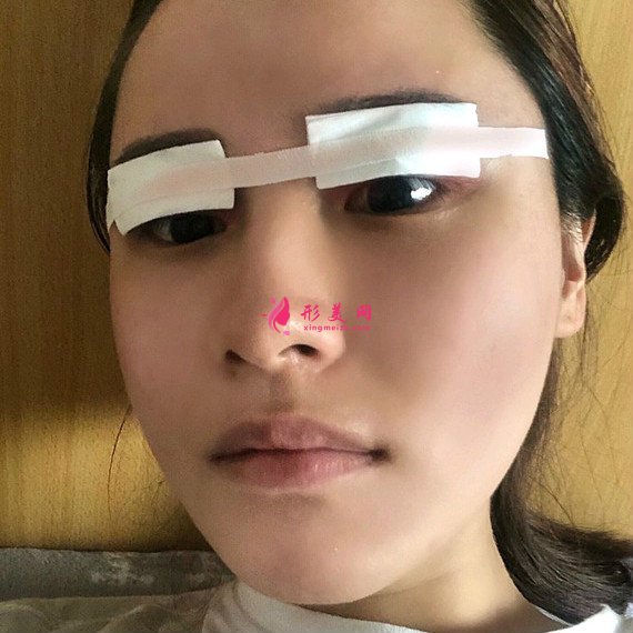 重庆美禅整形医院做的全切双眼皮效果还不错 重庆美禅整形医院做的全切双眼皮效果还不错