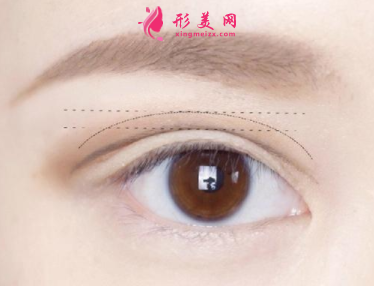 做眼睛皮手术会有疤痕出现吗？