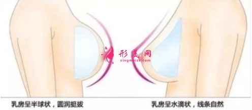 假体隆胸多长时间可以上班？