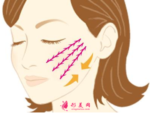 面部埋线后多长时间消肿？