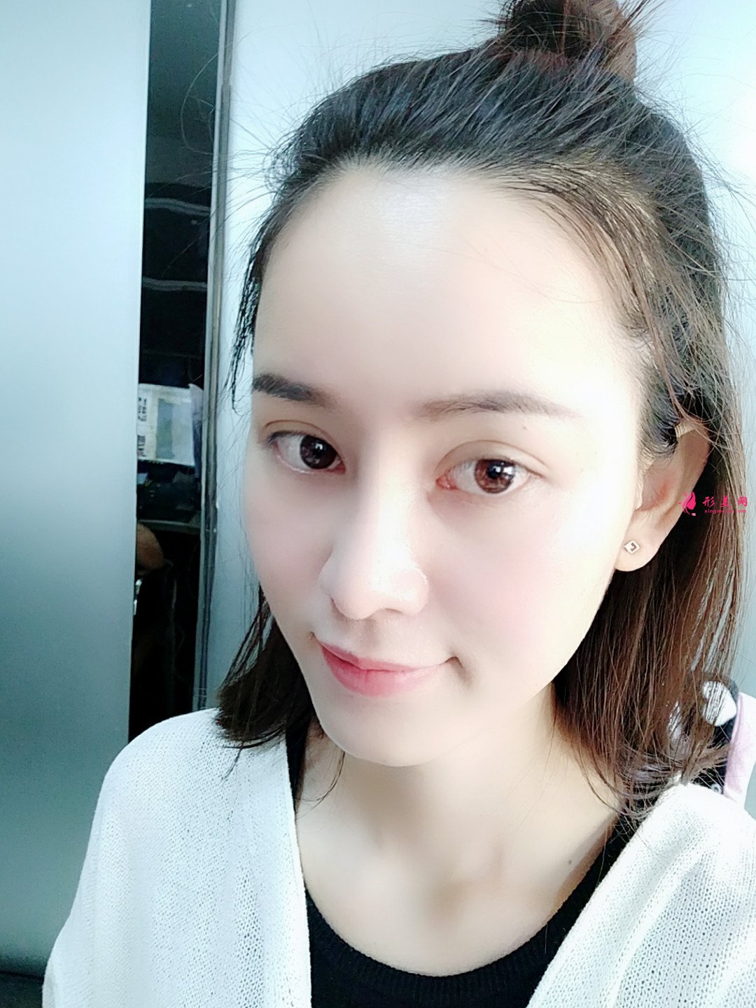 整形后