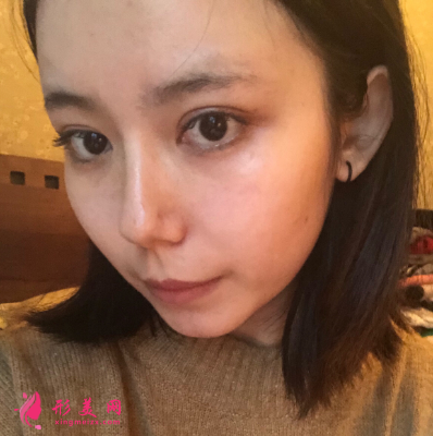 深圳非凡整形医院梅够明隆鼻手术